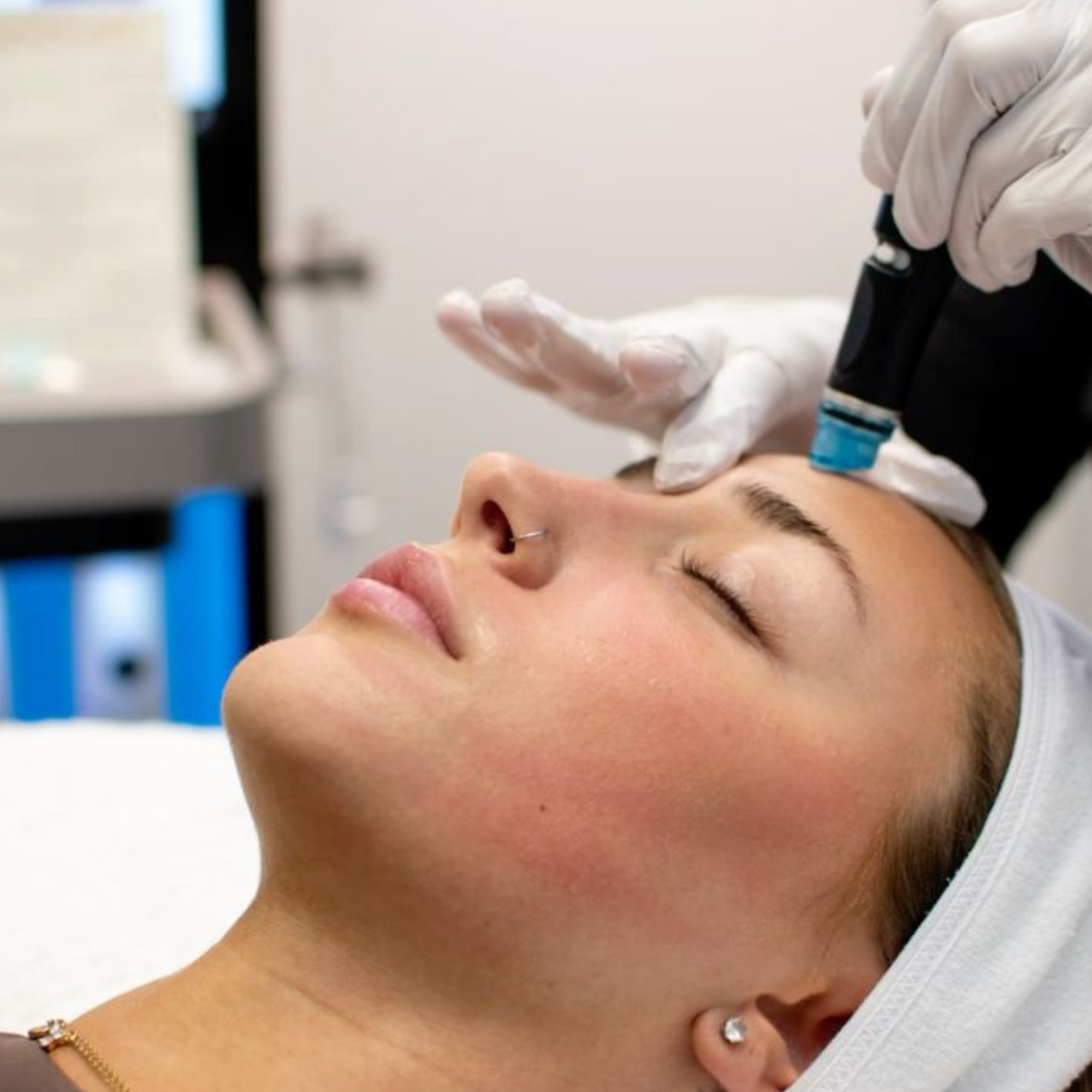 Microdermabrasion Toronto