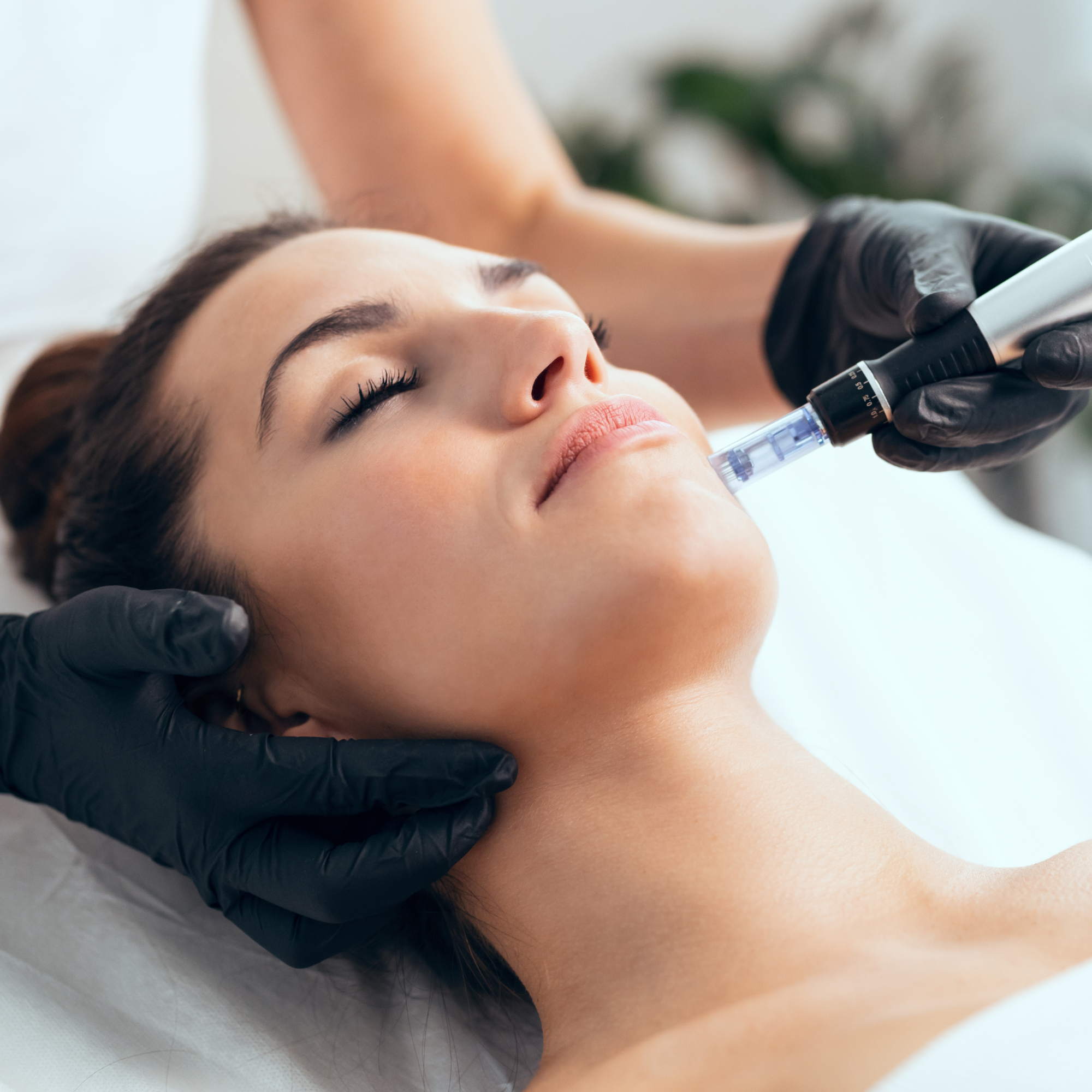 RF Fractional Microneedling Toronto