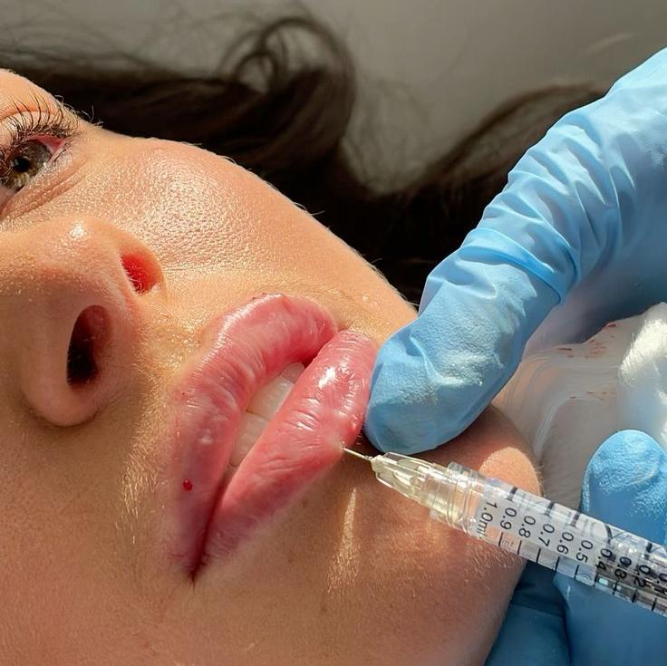 Dermal Fillers Toronto