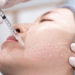 Mesotherapy Treatment Toronto