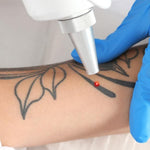 Laser Tattoo Removal Toronto