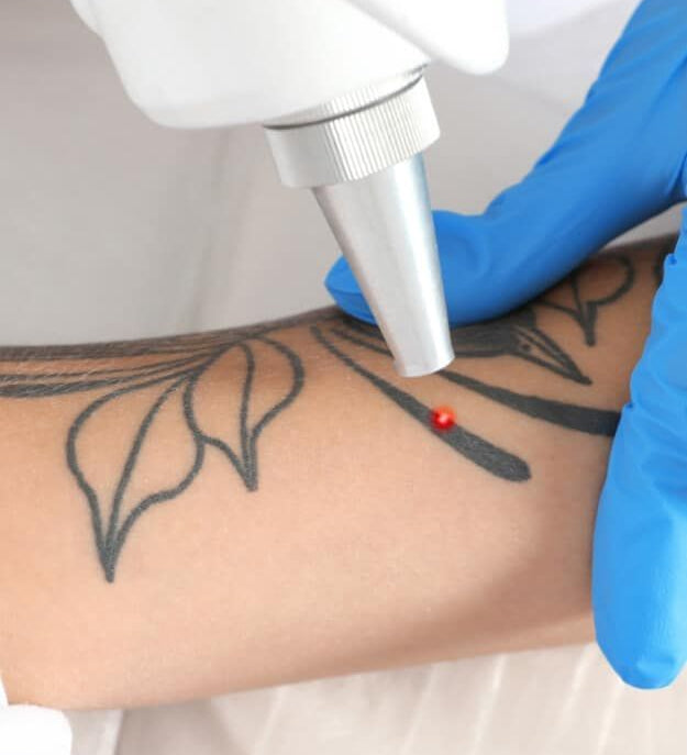 Laser Tattoo Removal Toronto