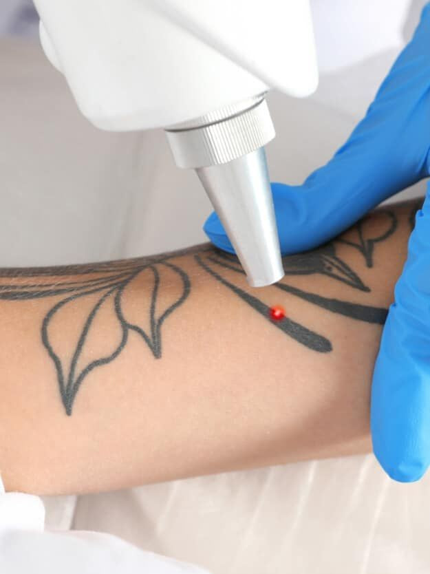 Laser Tattoo Removal Toronto