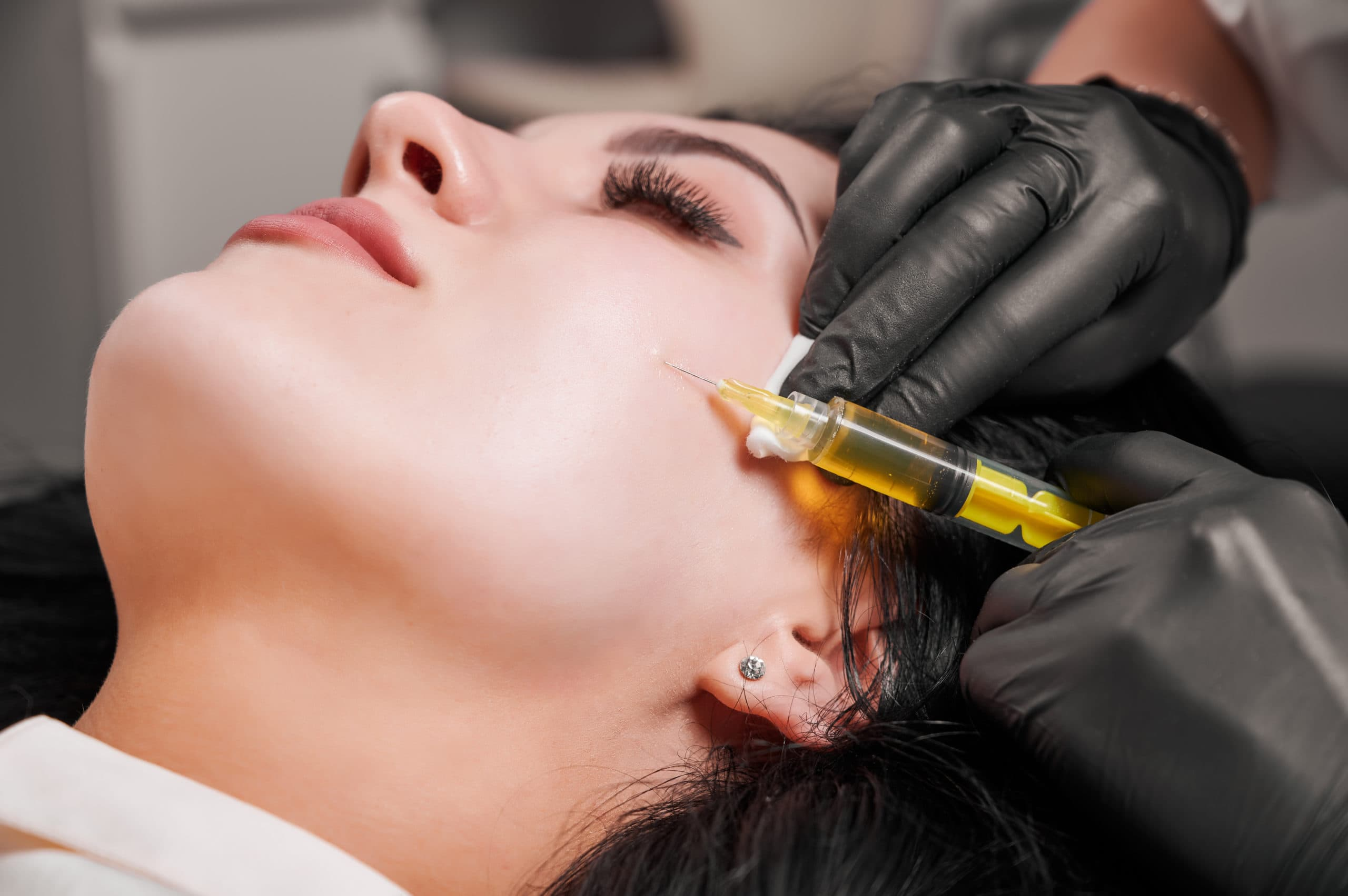 PRP Treatment For Face and Under Eyes Toronto