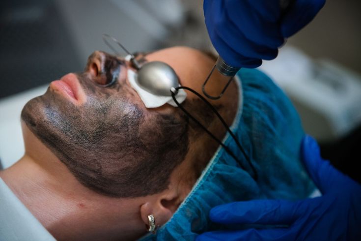 Carbon Laser Peel