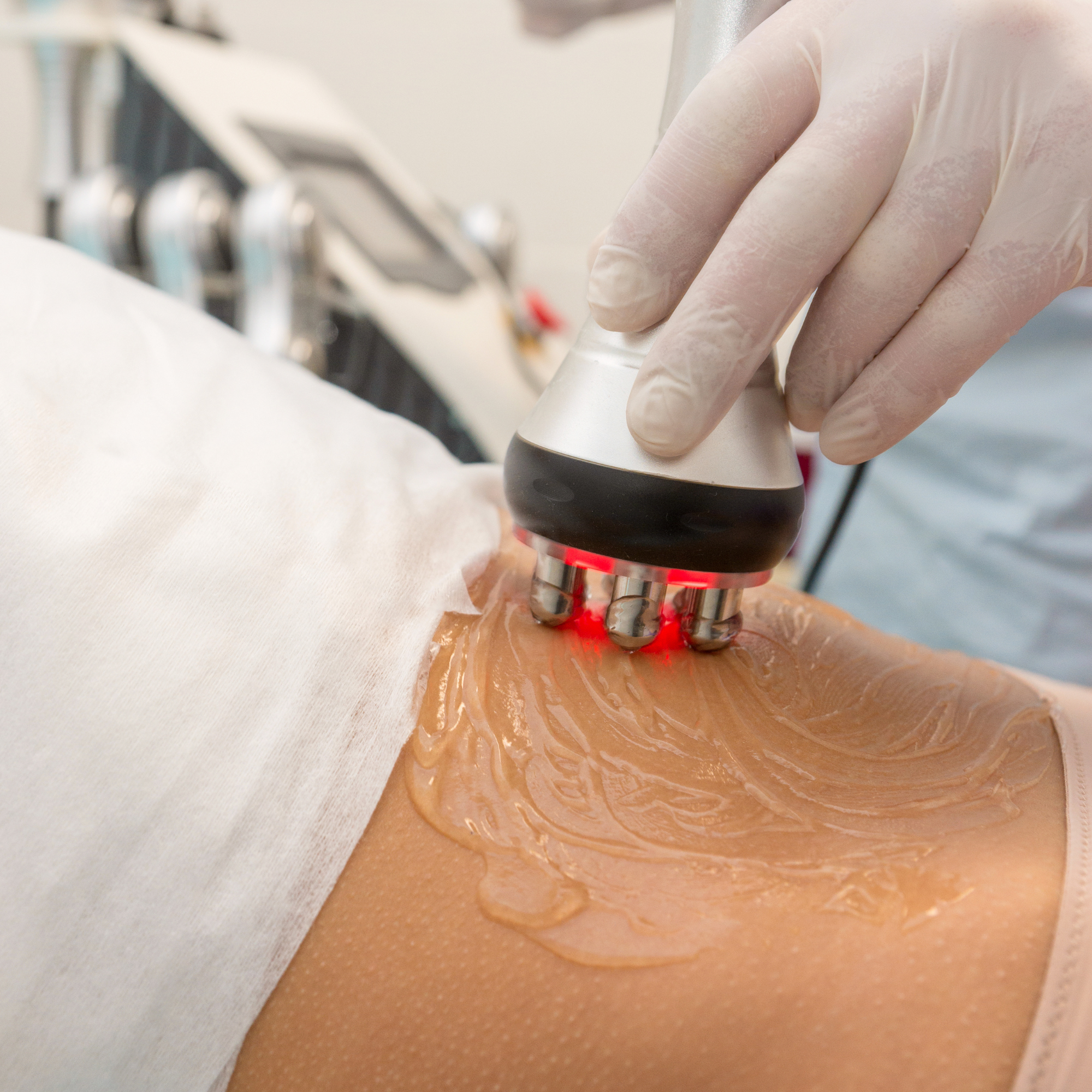 Skin Tightening Treatment Toronto